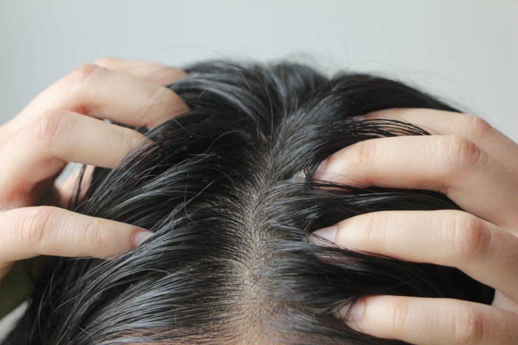 Close-up of a person scratching their oily, dandruff-covered scalp.