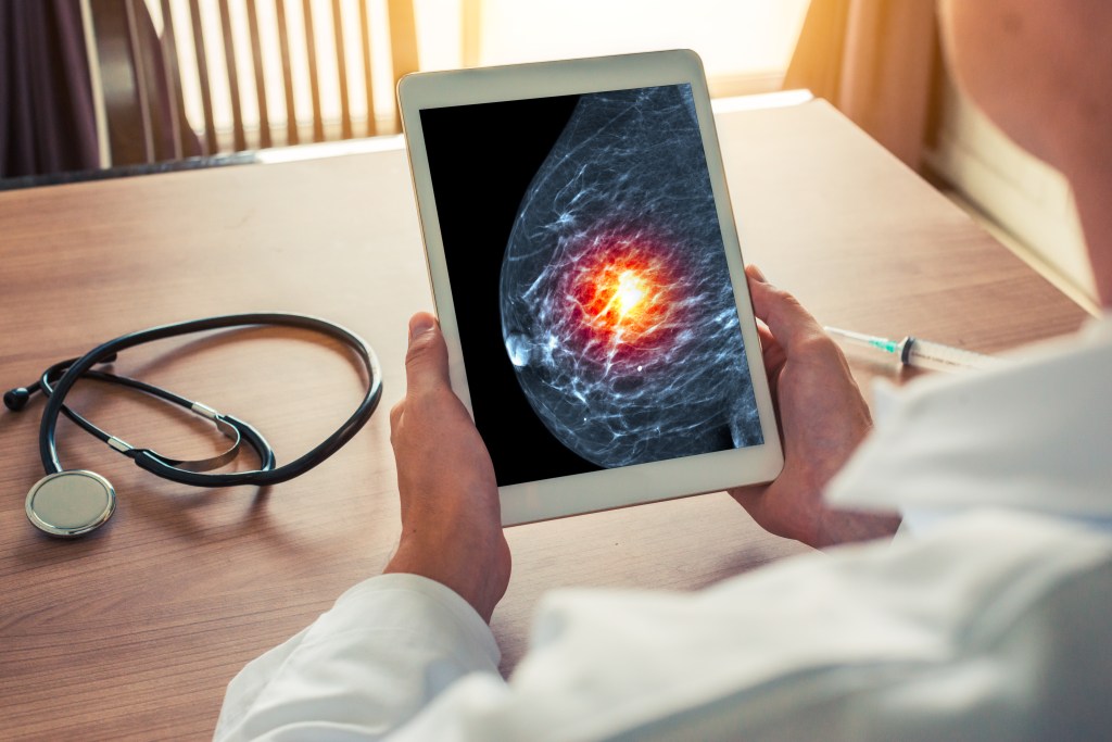 Doctor holding a tablet displaying a mammogram showing breast cancer.