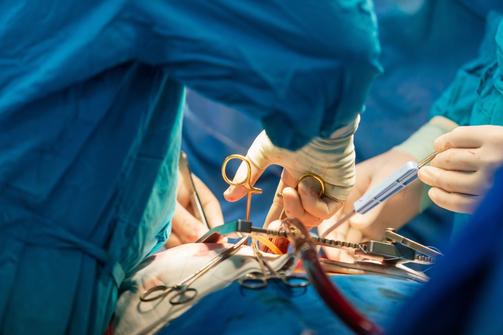Surgical team performing a heart transplant.