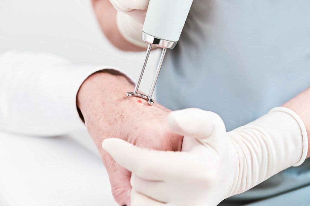 Dermatologist performing a skin laser treatment on an older patient's hand to remove a mole or melanoma.