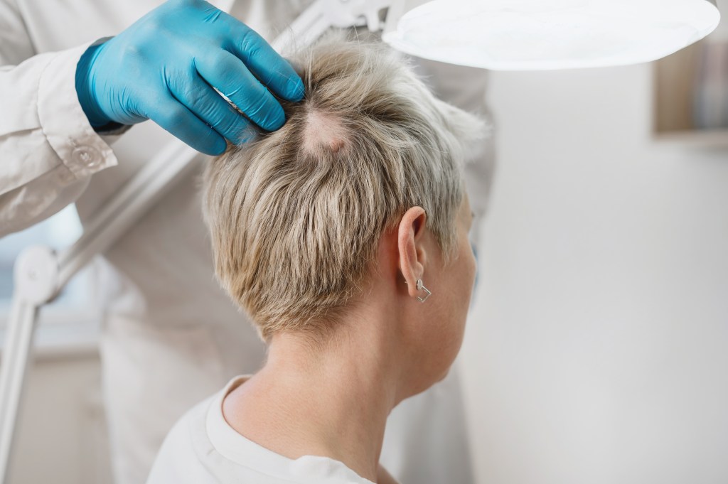 A trichologist examining a patient's scalp with a large mole and an area of alopecia.