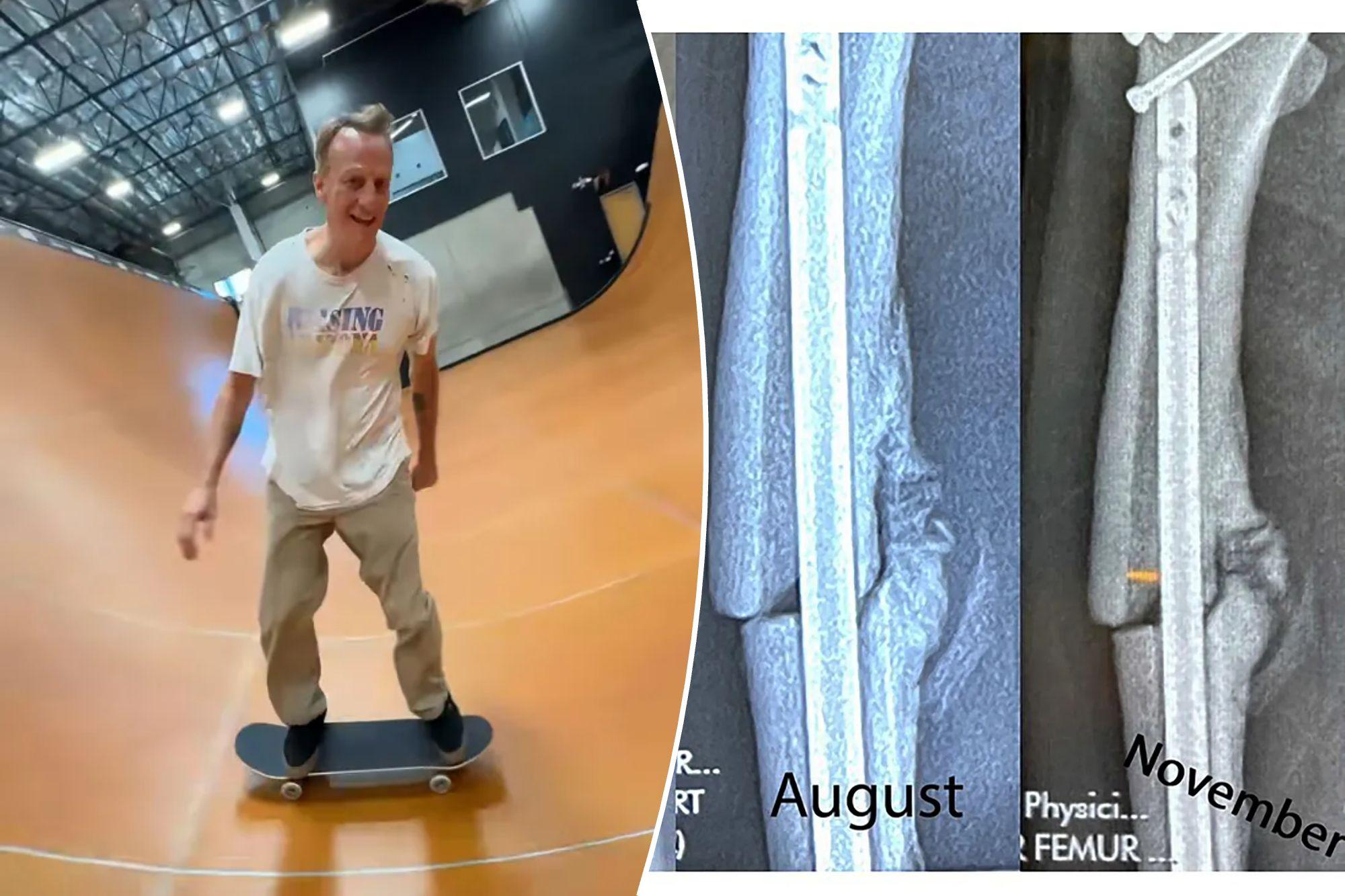 Tony Hawk says brutal injury taught him a lesson he wishes he’d learned decades earlier