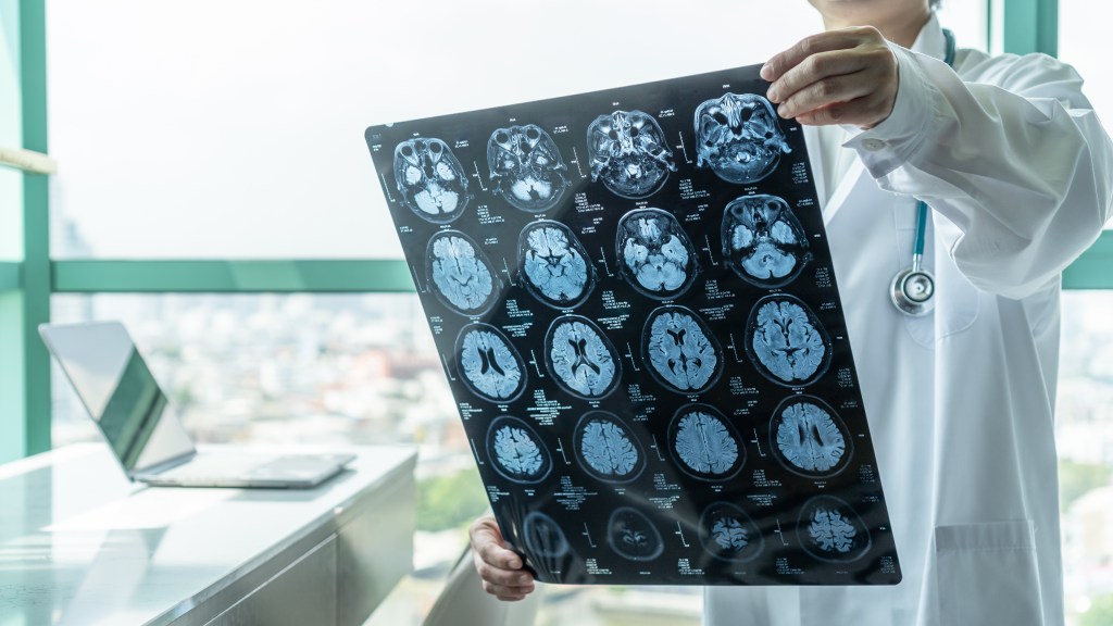 A special diet could help slow the growth of one of the deadliest brain tumors