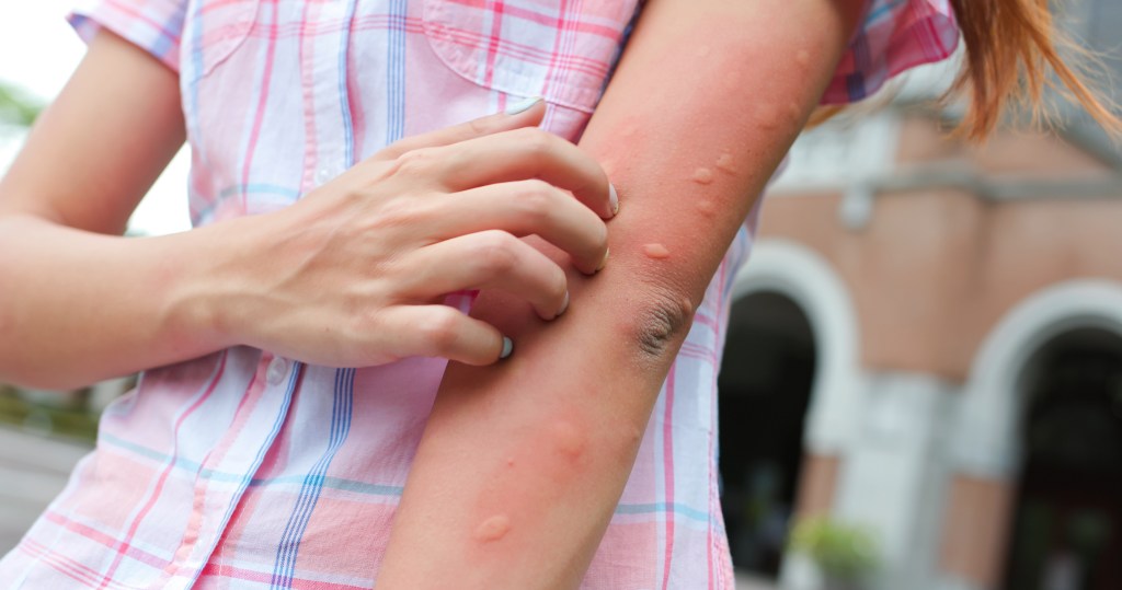 A girl's arm with multiple red mosquito bites and bumps, being scratched by her other hand.