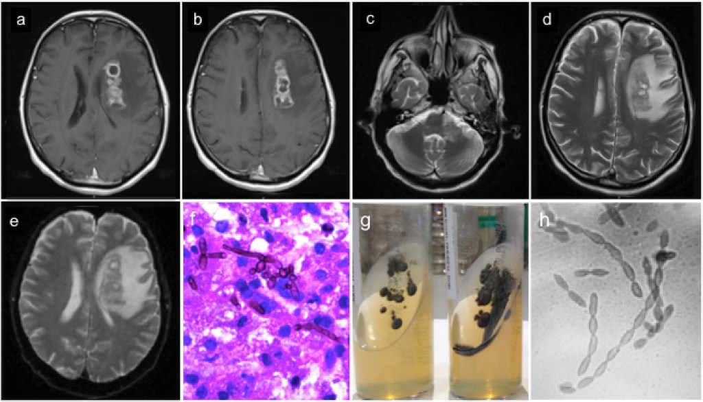 Collage of brain MRI scans showing lesions (a–e), a tissue biopsy with fungal elements (f), fungal cultures in test tubes (g), and microscopic fungal chains (h).