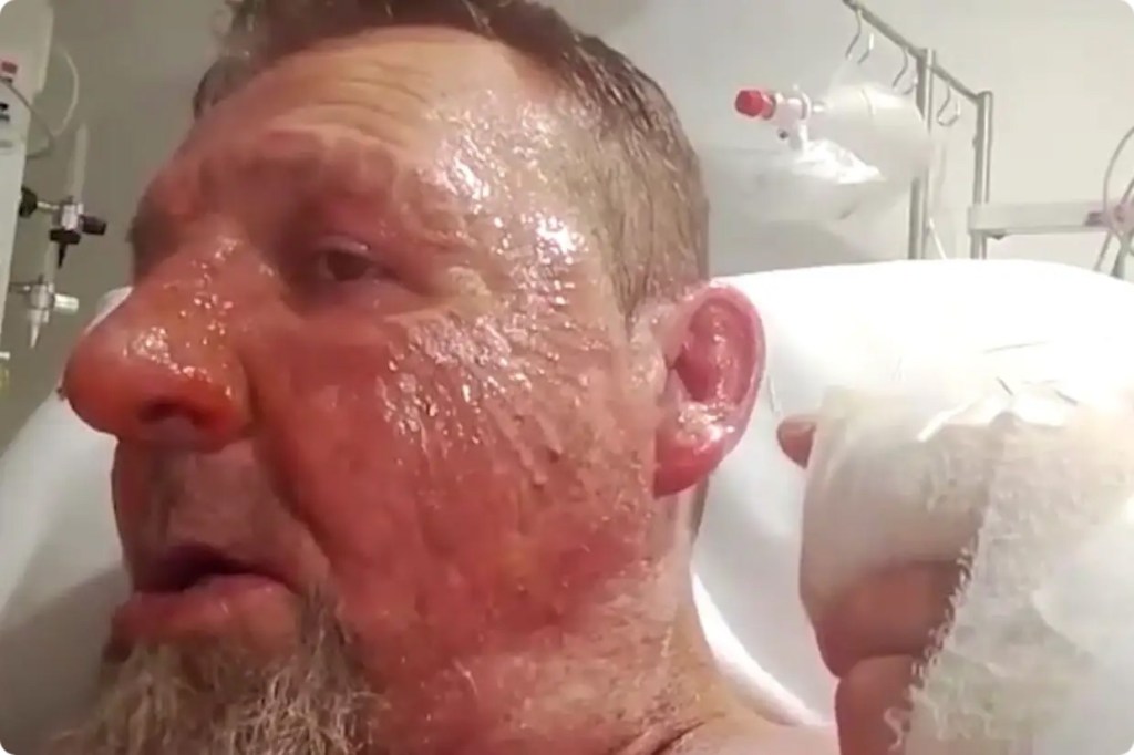 Randovan Banic with serious burns on his face and ear following a petrol attack inside a hospital.