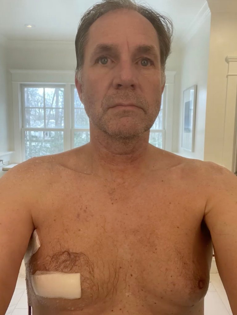 Robert Pfleghardt poses for a photo after undergoing treatment for breast cancer.